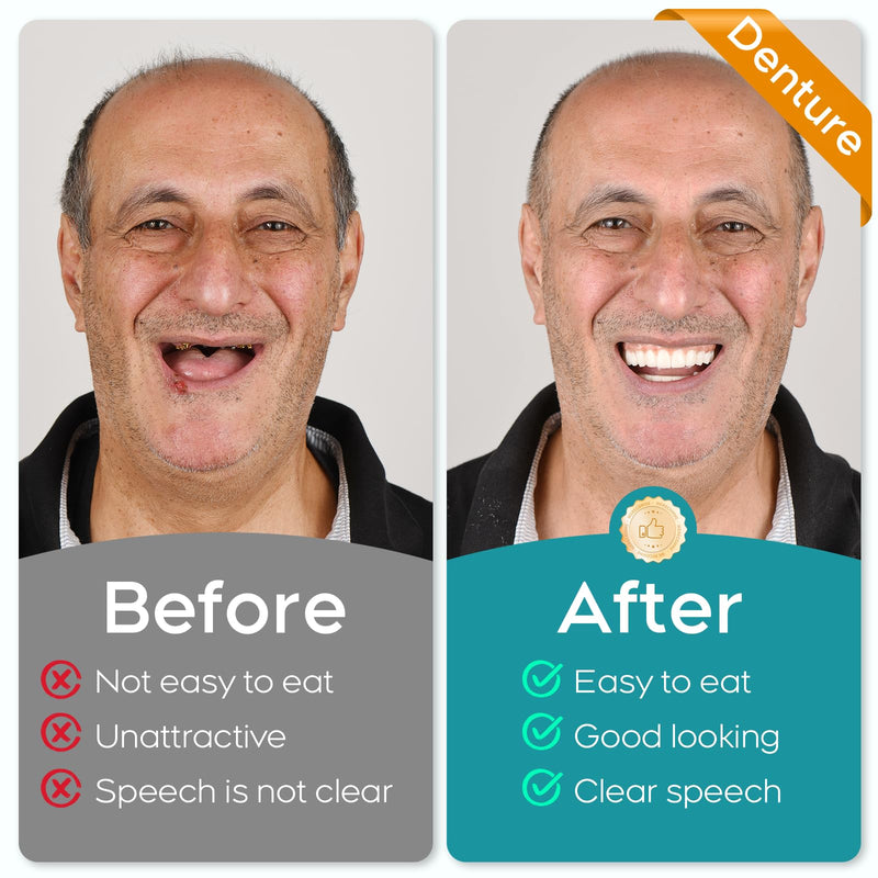 [Australia] - DIY Dentures Kit, Create Your Perfect Smile at Home: Temporary Denture Kit for Women & Men | Easy Denture Fabrication，Restoring Confidence in Your Smile，Customizable Denture Kits - Single, Full -0617 