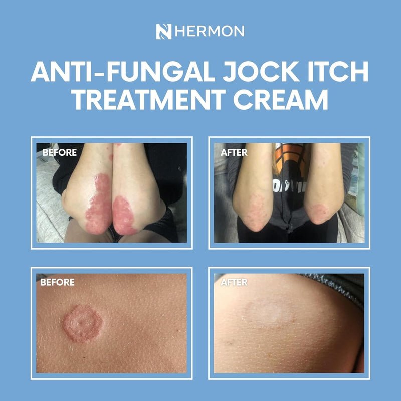 [Australia] - Jock Itch Antifungal Cream, Psoriasis Cream, Ringworm Treatment for Humans, Psoriasis Treatment, Psoriasis Scalp Treatment, Ringworm Cream for Humans, Foot & Body Balm, Provides Soothing Relief-100g 