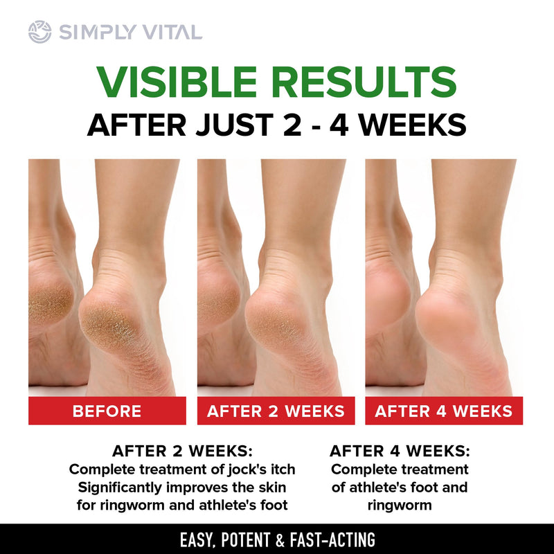 [Australia] - SimplyVital Antifungal Cream, Clotrimazole 1% - Made in USA Fast Acting OTC Cream - Relives Jock Itch, Ringworm and Athlete Foot - 2 oz 