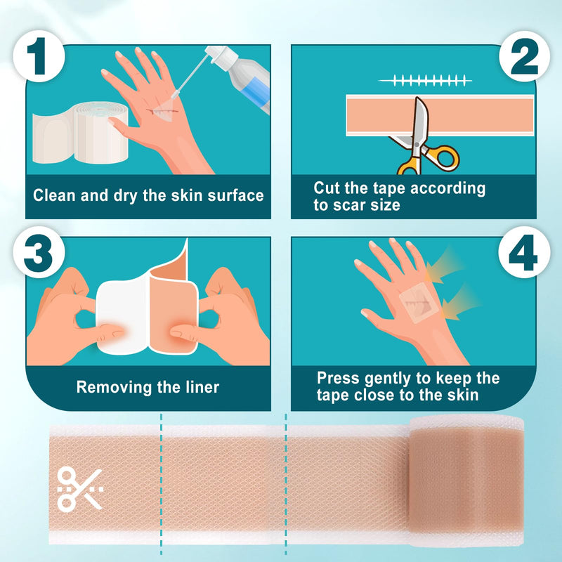 [Australia] - Arme Silicone Scar Tape, 1.6" x 240" Silicone Scar Sheets(2 Rolls-6M), Medical Grade Scar Tape Removal Sheets for Surgical Scars, Reusable Scar Removal Strips for Tummy Tuck C-Section Keloid 2 Pack 