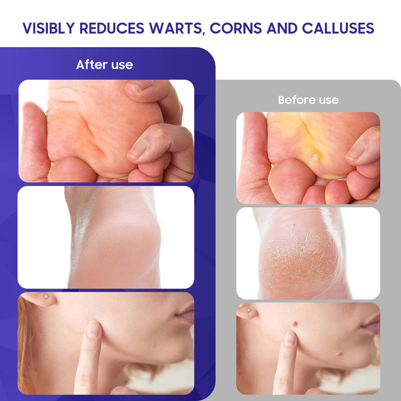 [Australia] - Wart & Corn Remover, 20% Salicylic Acid with Natural Formula, Maximum Strength Freeze Off, Fast-Acting for Warts, PlantarWart, GenitalWart, CommonWart, Callus-0.4 fl oz(12ml) 