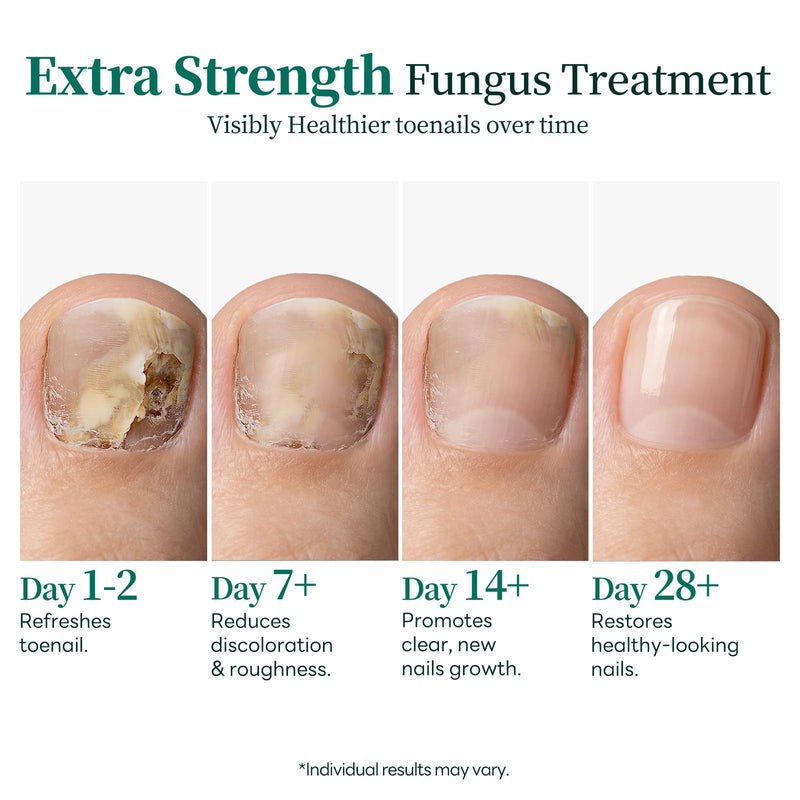 Apuree Nighttime Antifungal Pen Extra Strength 1% Tolnaftate Overnight | Tea Tree Oil, FSA-HSA Eligible, For Discolored Yellow Thick Brittle Damaged Nails, Improves Nail Appearance, Mess-Free
