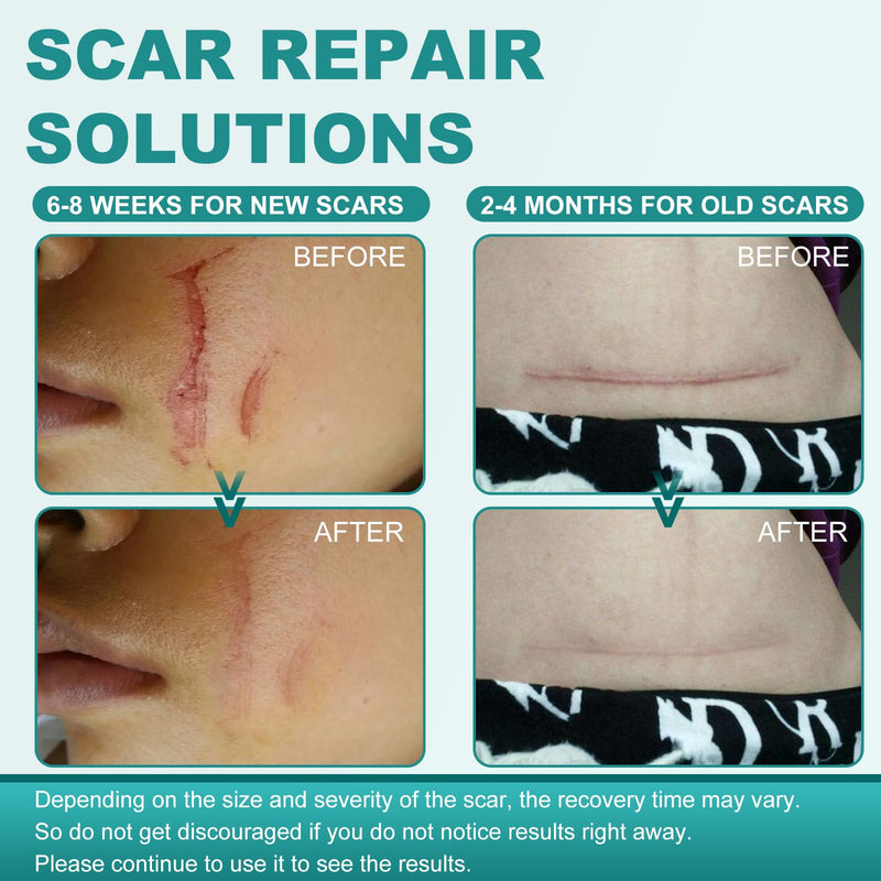 [Australia] - Silicone Scar Sheets, Silicone Scar Tape(1.6"x 158"), Scar Tape for Scar Removal Treatment, Reusable Silicone Scar Strips for Surgical, C-Section, Keloid, Burn, Acne, Surgical Scars 1.6"x 158" 