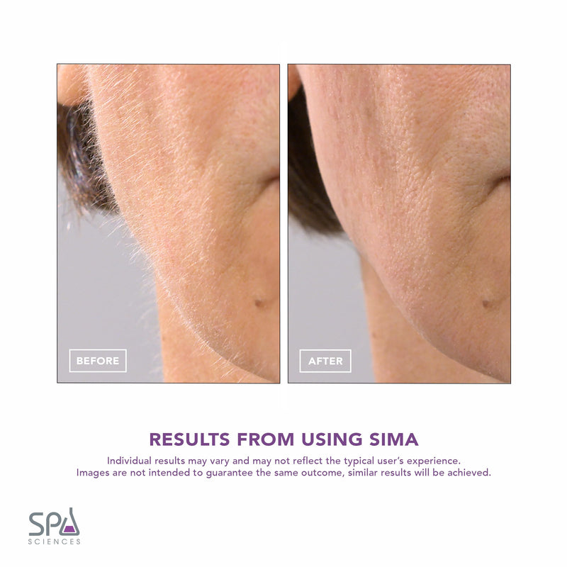 [Australia] - SPA SCIENCES - SIMA Patented Dermaplane Razor for Women Face – Painless 2-in-1 Facial Exfoliation & Peach Fuzz Hair Removal – Anti-Aging – 3 Speeds – Rechargeable – 7 Weeks Treatment Pink 