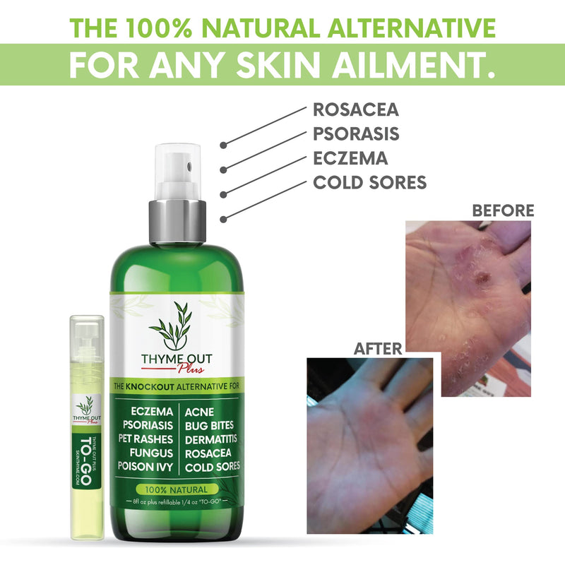 [Australia] - Plus Eczema Treatment, Psoriasis Treatment Treats Acne, Dermatitis, Rosacea, Cold Sores, Pet Rashes, Bug Bites, Poison Ivy, Anti Itch Spray for Itchy Skin Relief for Kids, Adult & Baby 8 Fl Oz (Pack of 1) 
