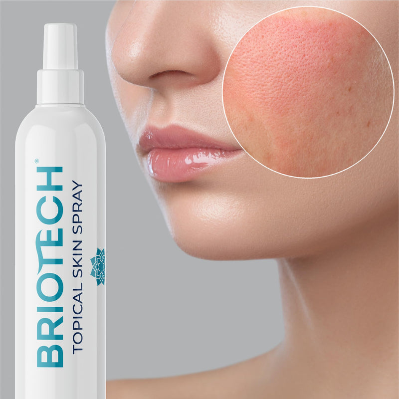 [Australia] - BRIOTECH Topical Skin Spray, Hypochlorous Acid Spray for Body & Face, Eyelid Cleanser, HOCl Facial Mist, Support Against Irritation, Calm Redness, Soothe Foot & Scalp, Packaging May Vary, 3.4 oz, 1 ct 3.4 Fl Oz (Pack of 1) 