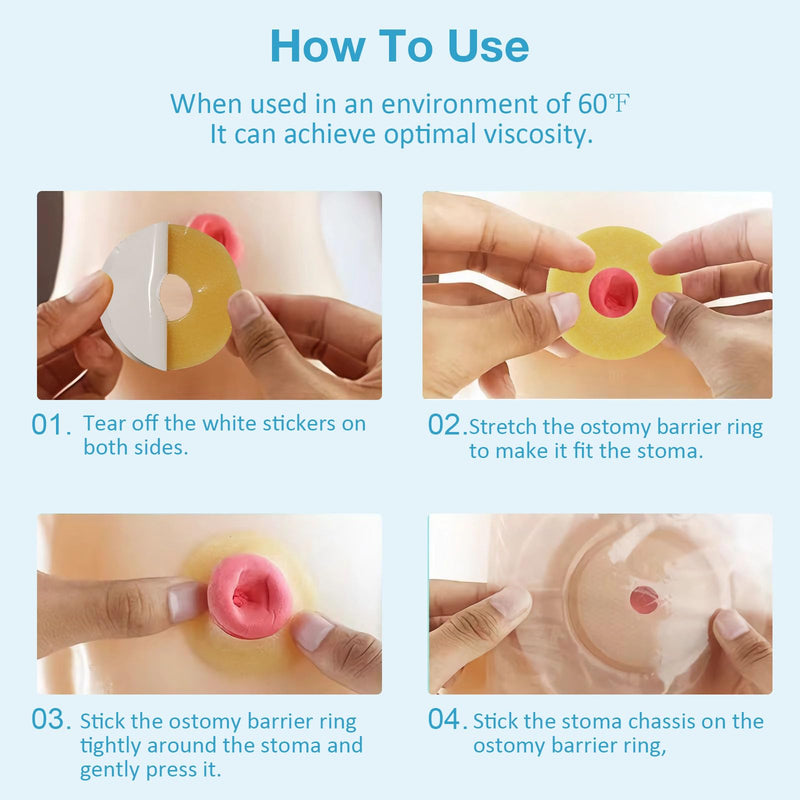 [Australia] - 20PCS Moldable Ostomy Barrier Rings, Elastic Skin Extender Rings, 2mm Thickness Medical Hydrocolloid Ostomy Bag Supplies, Better Seal No Leaking Skin Barrier Ring for Colostomy Bags 20 PCS 