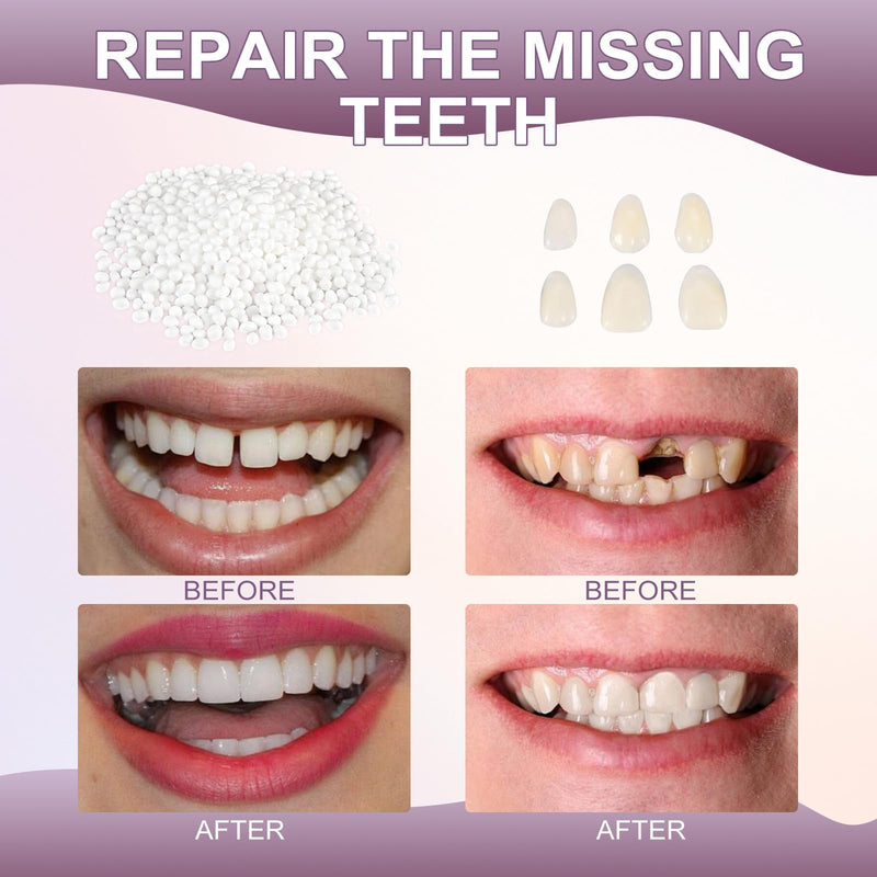 [Australia] - Tooth Repair kitÔºåTeeth Repair Kit for Filling The Missing Broken Tooth and Gaps-Moldable Fake Teeth and Thermal Beads Temporary Replacement Kit-L002 