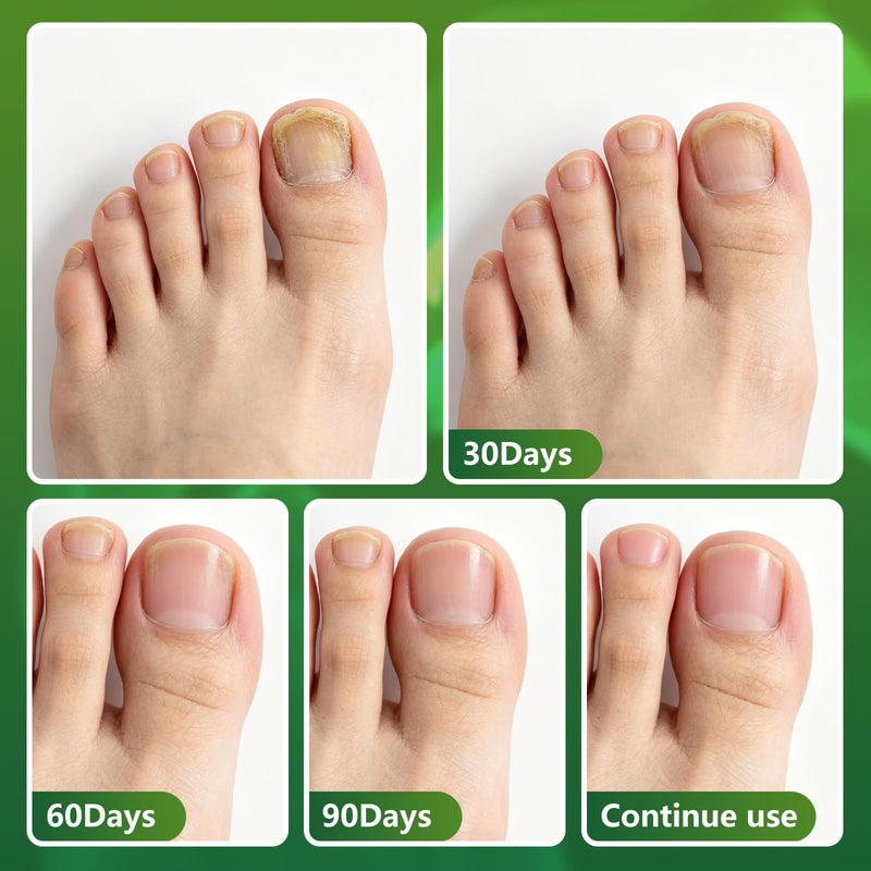 2026 Upgraded Nail Fungus Pen, Toenail Fungus Treatment Extra Strength, 25% Undecylenic Acid Ingrown Toenail Treatment - 5 Pack