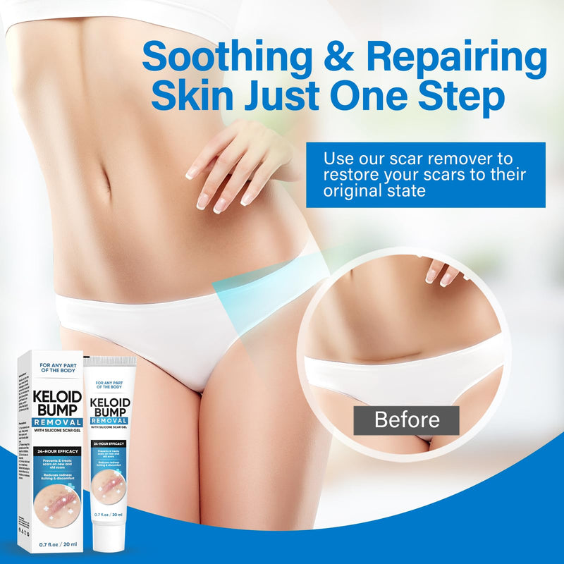 [Australia] - Scar ointment, medical silicone scar cream gel for reduced visible surgical scars, burns, keloid, acne scars, injuries 