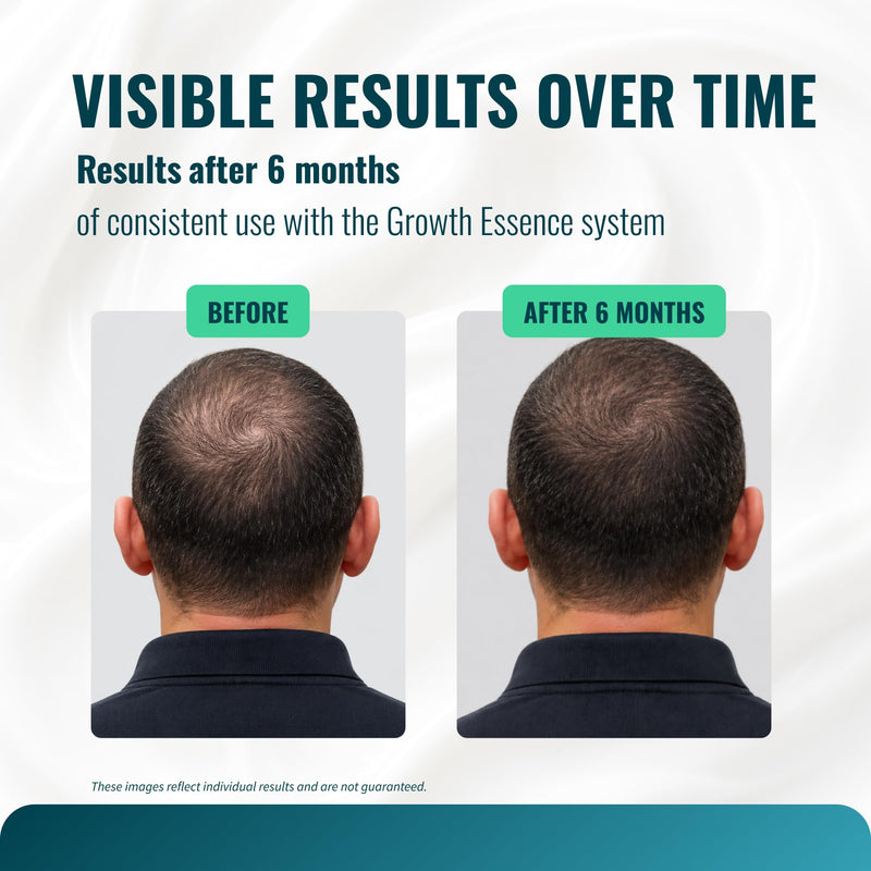 Hair Growth & Thickening Vitamins for Thinning Hair with Biotin 5,000mcg, Saw Palmetto & Collagen – DHT Blocker for Men & Women, 90 Vegetable Capsules