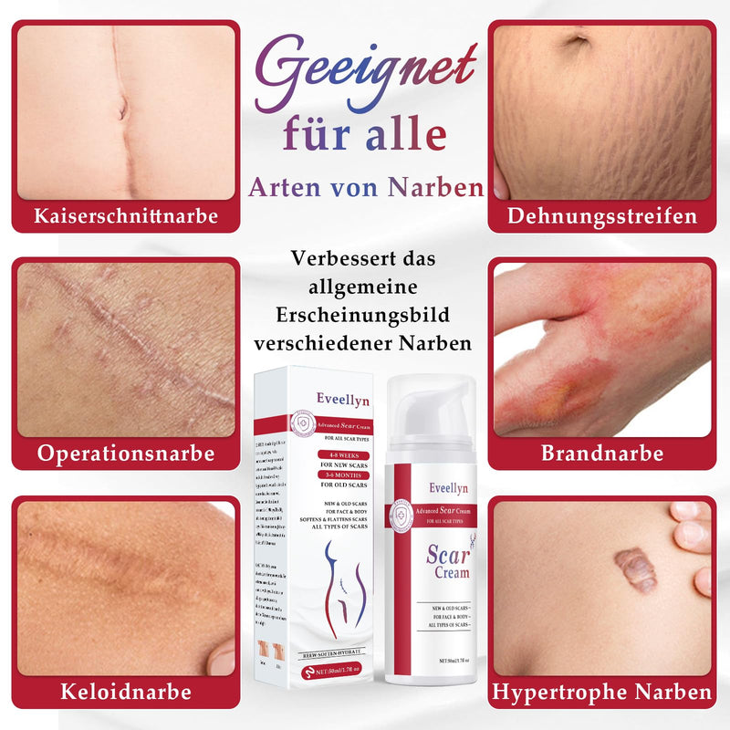 [Australia] - Eveellyn Scar Ointment, Scar Gel, Advanced Scar Cream for Surgical Scars, Stretch Marks, Keloid Scars, Cesarean Section, Burns, Acne, Treats Old and New Scars (1 Pack) 1 Pack 