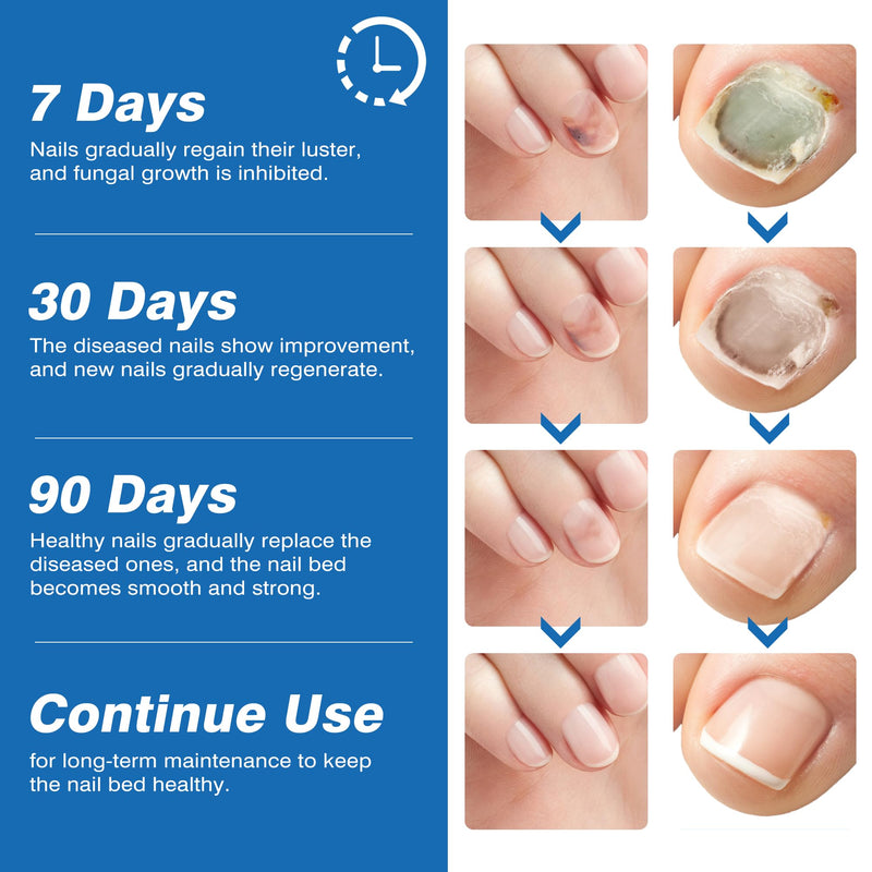 [Australia] - Toenail Fungi Treatment Extra Strength - Fungi Nail Pen Antifungal Repair for Damaged Nails, Fast-Acting Solution for Toe & Fingernail Fungi, Ideal for Nail Health Concerns Athletes 5ml/0.18FLOZ 3Pcs 1 Count (Pack of 3) 