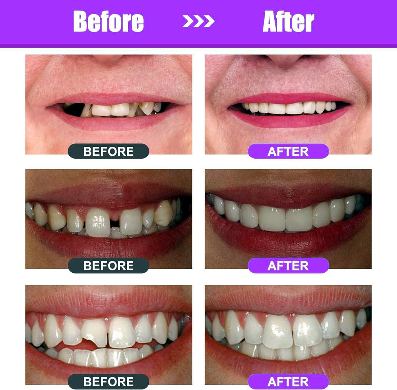 [Australia] - Tooth Filling Repair Kit, Moldable Tooth Repair Kit for Men and Women, Regain Your Confident Smile 