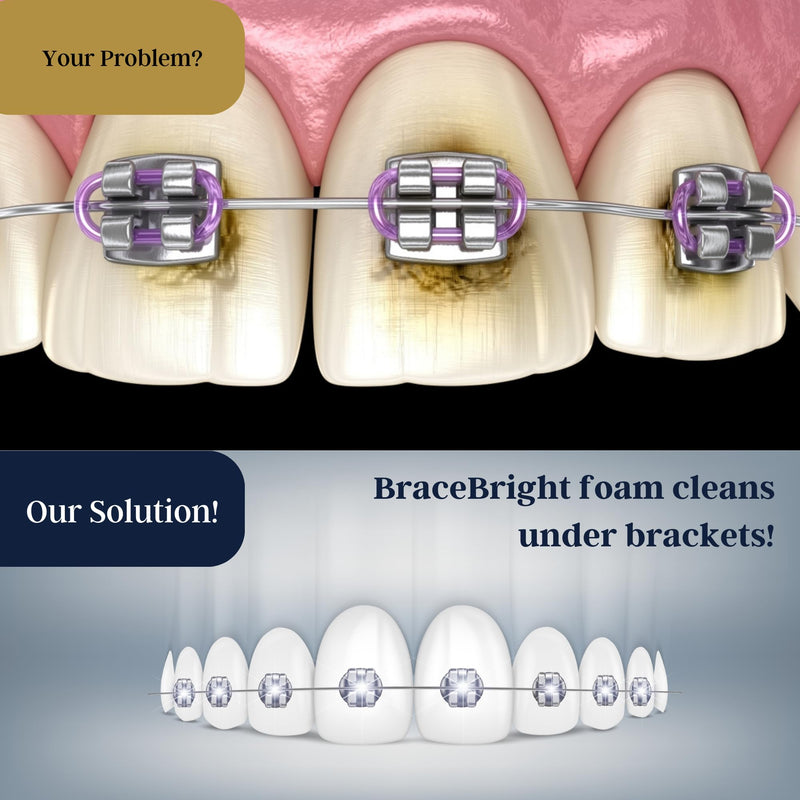 [Australia] - Teeth Whitening for Braces Cleaner kit under metal, ceramic, clear brackets & wires. Use w/ Toothbrush, Rinse or in Trays. No Sensitivity. Fights Plaque, Minty Foam, Kid Friendly, Tooth Stain Remover 