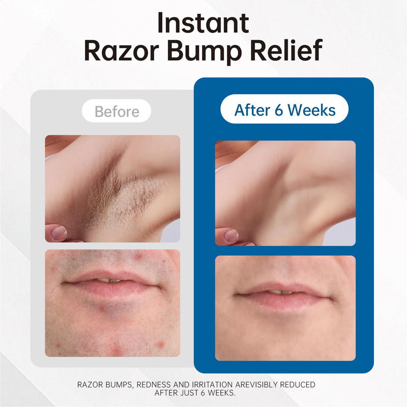 [Australia] - Morovan Razor Bumps Treatment: Ingrown Hair & Razor Burn Solution for Bikini Beard & Body for Women and Men 100ml 