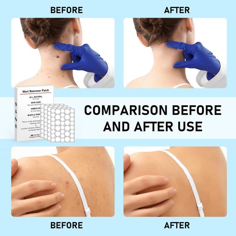 [Australia] - WABRINY Wart Remover Patches, Fast & Easy Operate Hydrocolloid Gel Waterproof Invisible Sticker, Skin Care Removal Patches for Home Daily Use-8KZ 1 Box 