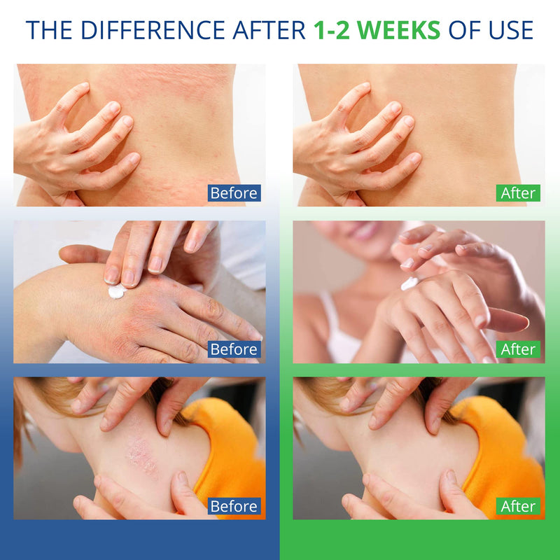 [Australia] - Jock Itch Antifungal Cream, Psoriasis Cream, Ringworm Treatment for Humans, Psoriasis Treatment, Psoriasis Scalp Treatment, Ringworm Cream for Humans, Foot & Body Balm, Provides Soothing Relief-100g 
