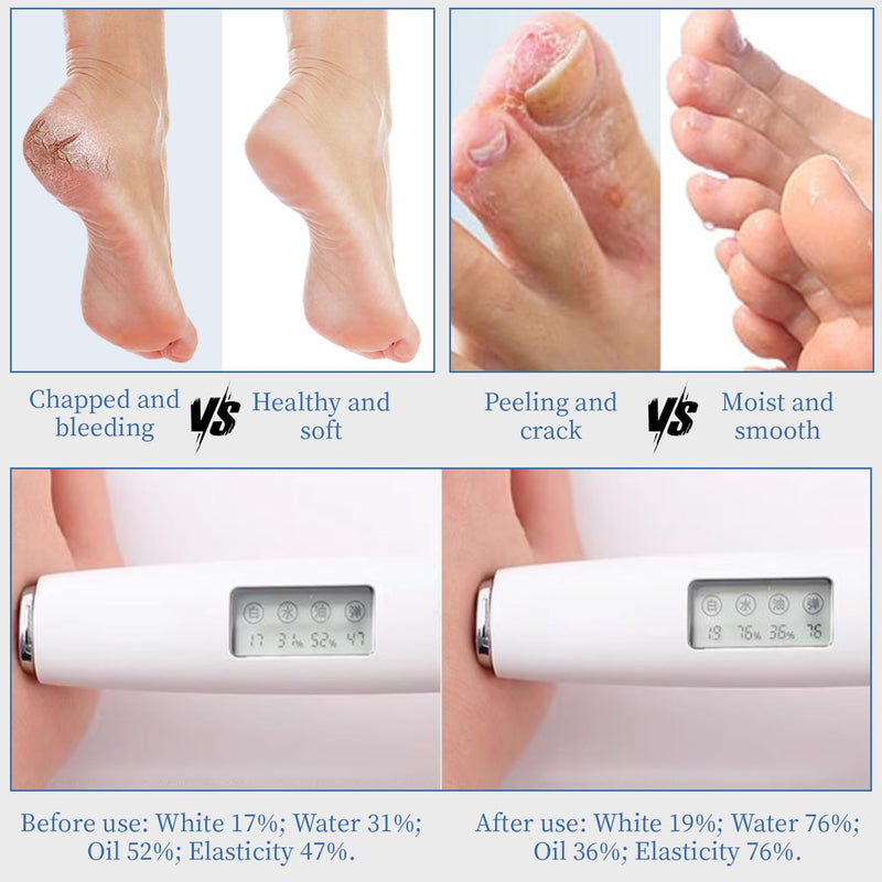 10.1 Oz - Urea Cream 70% plus Salicylic Acid 2% for Dry Cracked Feet, Heels, Knees, Elbows and Hands, Moisturizes, Softens and Removes Calluses Dead Skin Dark Blue 10.1 Ounce (Pack of 1)