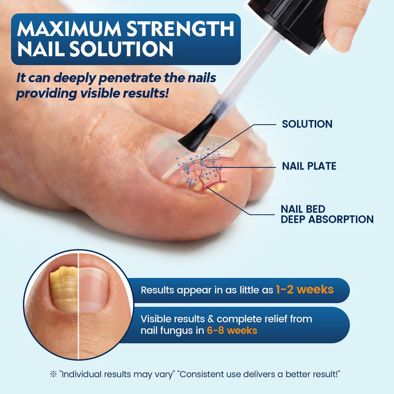 Toenail Fungus Treatment Extra Strength, Nail Fungus Treatment for Thick, Discolored Fungi Nails - 25% Undecylenic Acid All-in-One Kit with 30ML Fungi Nail Solution, 2 Nail Repair Pens