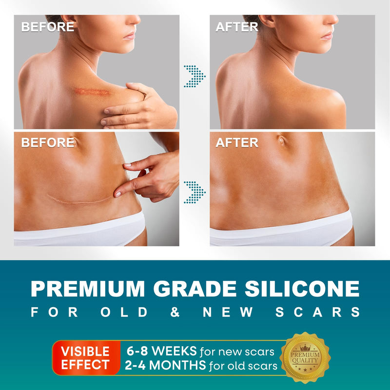 [Australia] - Scar Plaster, Scar Roller, Silicone Plaster for Scars, Scar Care, Silicone Scar Plaster for C-Section, Surgery, Burns, Keloid, Acne [Large, 4cmx300cm] Silicone Plasters for Scars 