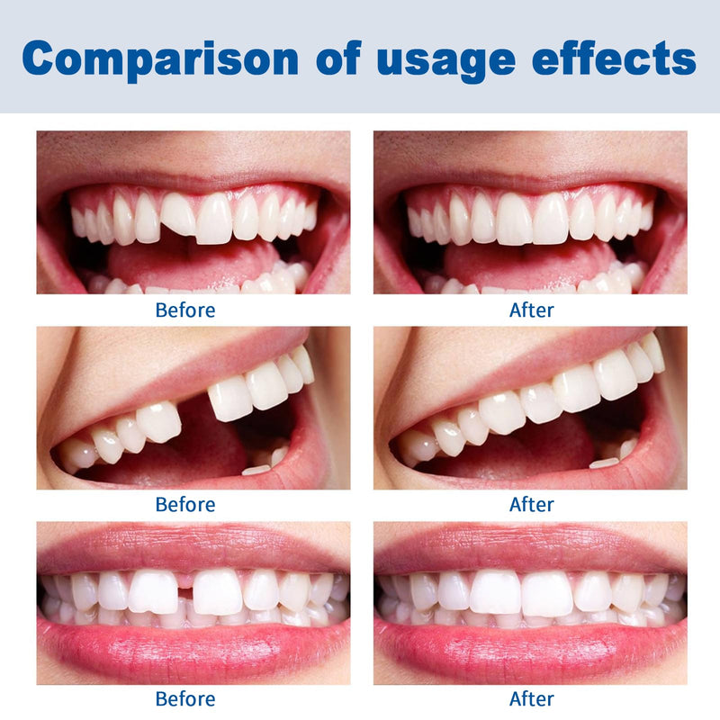 [Australia] - Tooth repair set, make your own dentures, tooth repair set, polymorphic teeth, dentures, temporary teeth, dentures for clipping on, artificial teeth, fake teeth, dental filling 