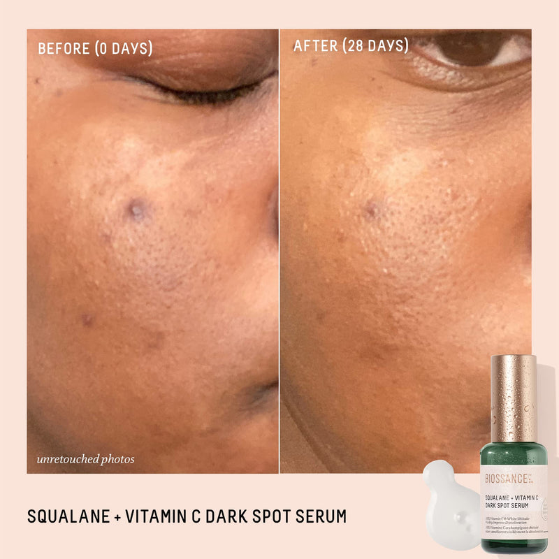Biossance Squalane + Vitamin C Dark Spot Face Serum – 10% Vitamin C Serum & White Shiitake – Hydrating, Fragrance-Free, Non-Irritating, for Daily Use for All Skin Types 1.01 Fl Oz (Pack of 1)