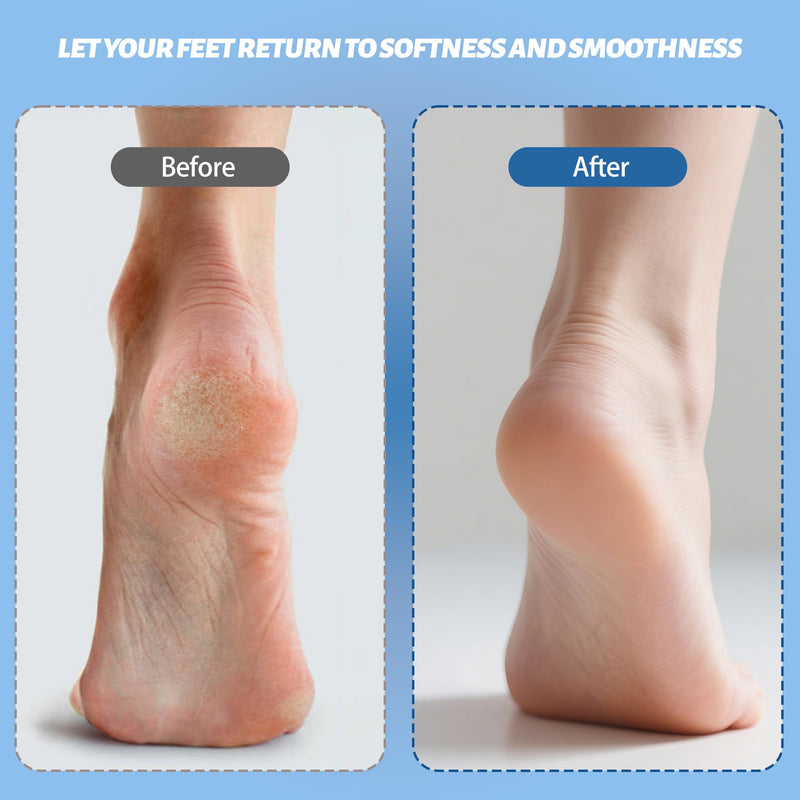 [Australia] - Electric Feet Foot Callus Remover Equipped with A Vacuum System Foot Scrubber 17 in 1 Professional Foot Care Tool Ipx6 Waterproof Rating for Removing Hard Cracks Dryness and Dead Skin (White) White 