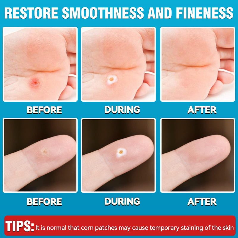 [Australia] - AstraVox 24Pcs Corn Removers for Toes Feet with Adhesive PU Waterproof Membrane, Plantar Corn Remover Bandaid Pads Kit for Hand, Highly Effective, Pain Relief, Easy to Use (Large) Large 