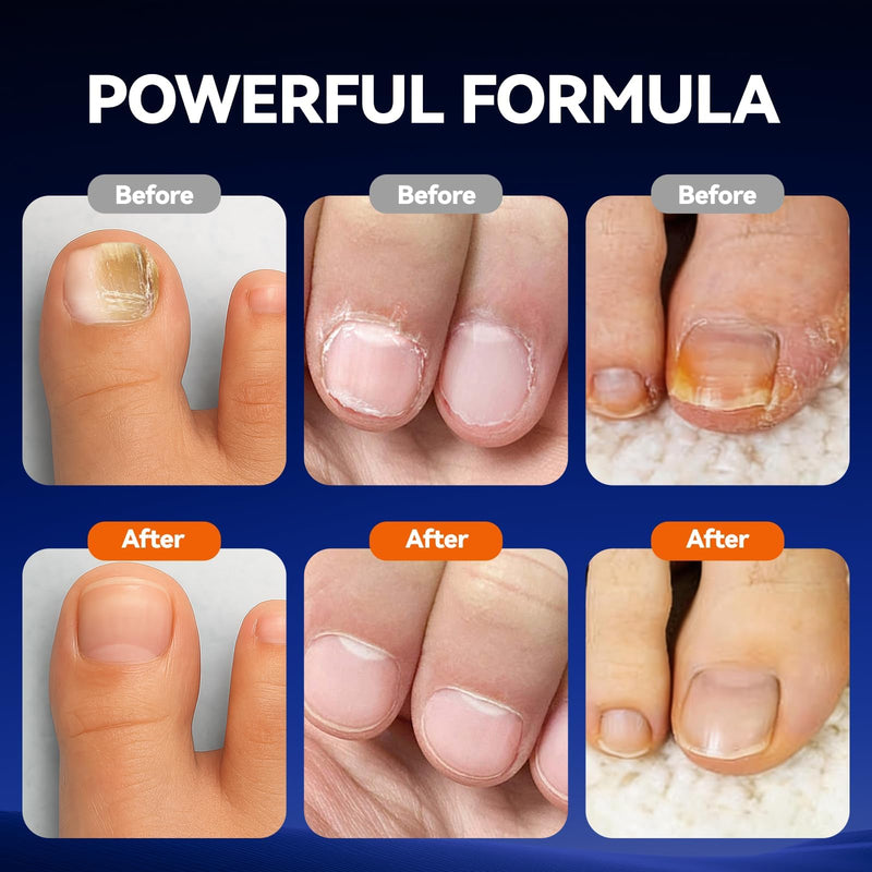 Toenail Fungus Pen, 25% Undecylenic Acid- Repairs Yellow Thick Brittle Toe and Fingernails - 5 Pens with 1 Nail Files