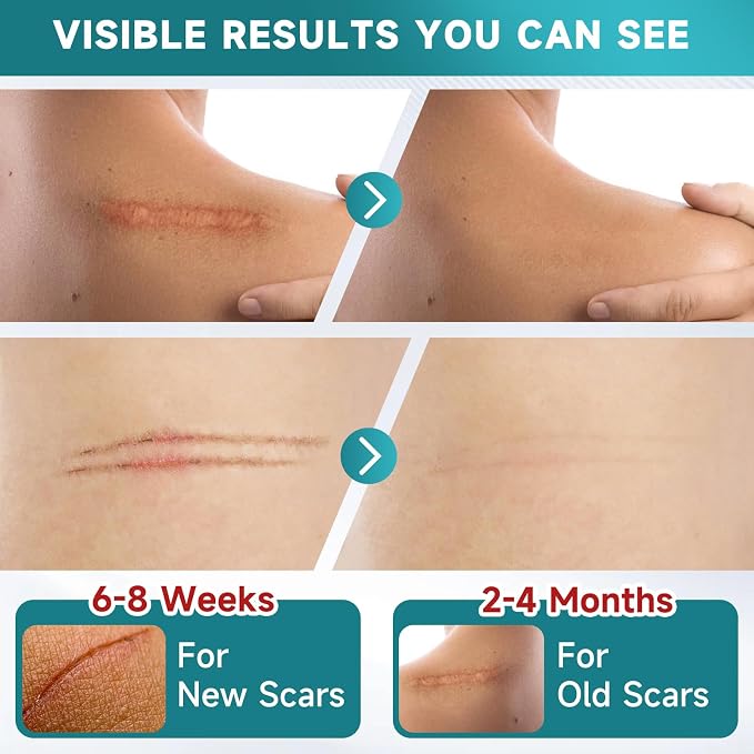 Medical-Grade Silicone Scar Tape Roll (1.6" x 118") Silicone Scar Sheets Keloid Bump Removal - Reusable Silicone Tape Scar Removal Strips, Scar Tape for Surgical Scars, C Section Scar Silicone Strips 1 Pack