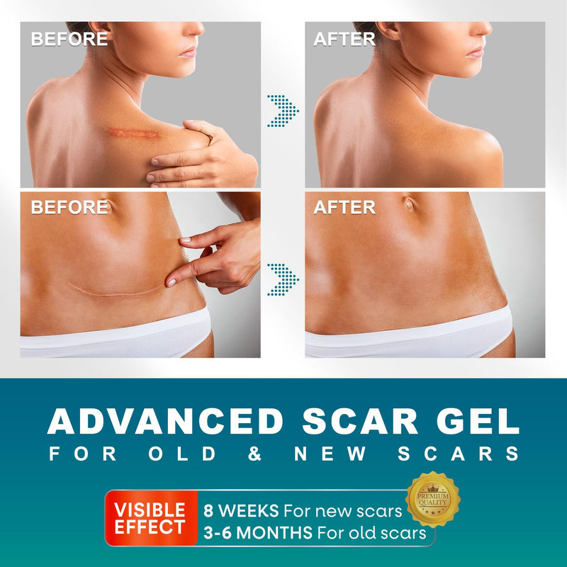 [Australia] - Scar gel 50g scar cream for C-section, operations, burns, keloid, acne, scar gel that can be used with scar tape (4cmx300cm) 