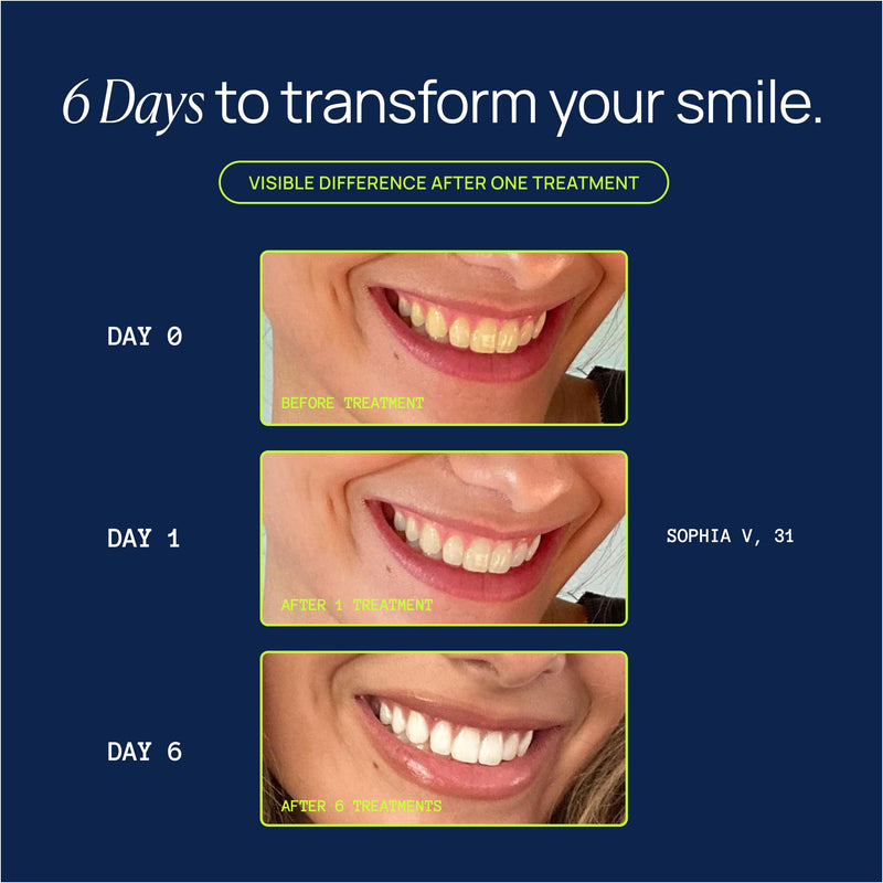 Laughland Original Teeth Whitening Kit, Phone-Powered LED Mouthpiece & 3 Whitening Gel Syringes, 8% Hydrogen Peroxide, Aloe Vera & Mint, for Sensitive Teeth, At-Home Dental Care, 6+ Treatments 1 Count (Pack of 1)