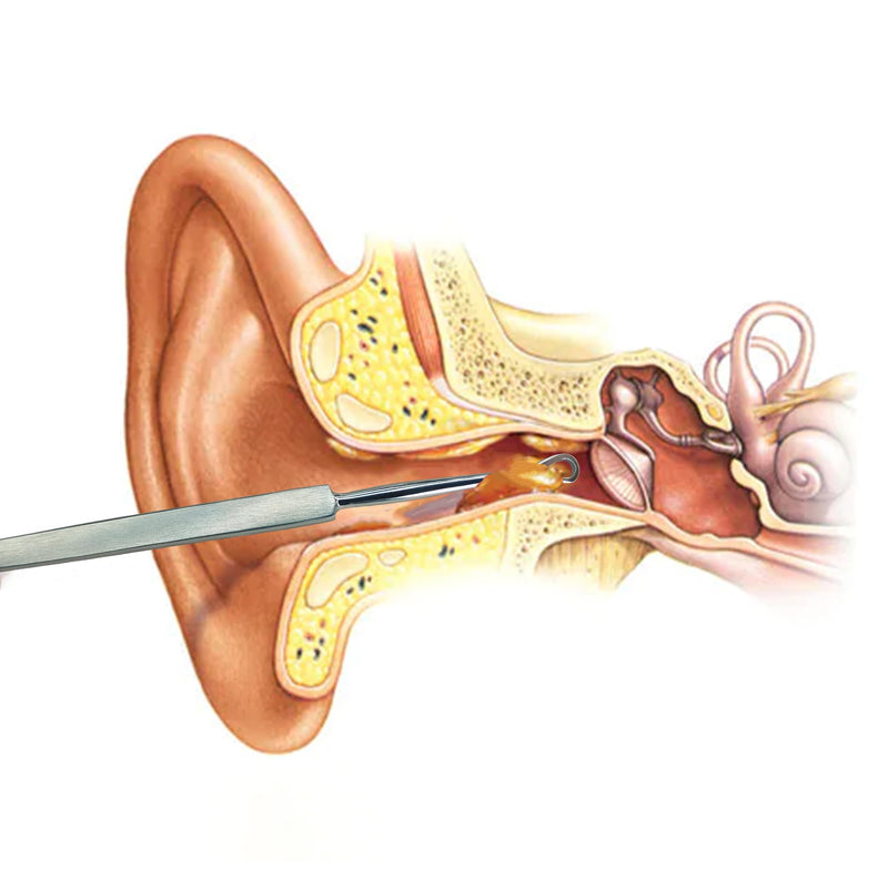 [Australia] - MJW Professional earwax remover made of stainless steel ear loop for removing ear irrigation, reusable ear cleaner tool for adults and children, hygienic earwax removal 