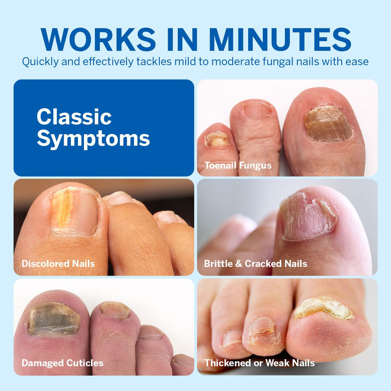 [Australia] - Toenail Fungus Treatment Extra Strength: Nail Fungus Treatment for Toenail - Fungal Nail Repair Pen 4 Packs 