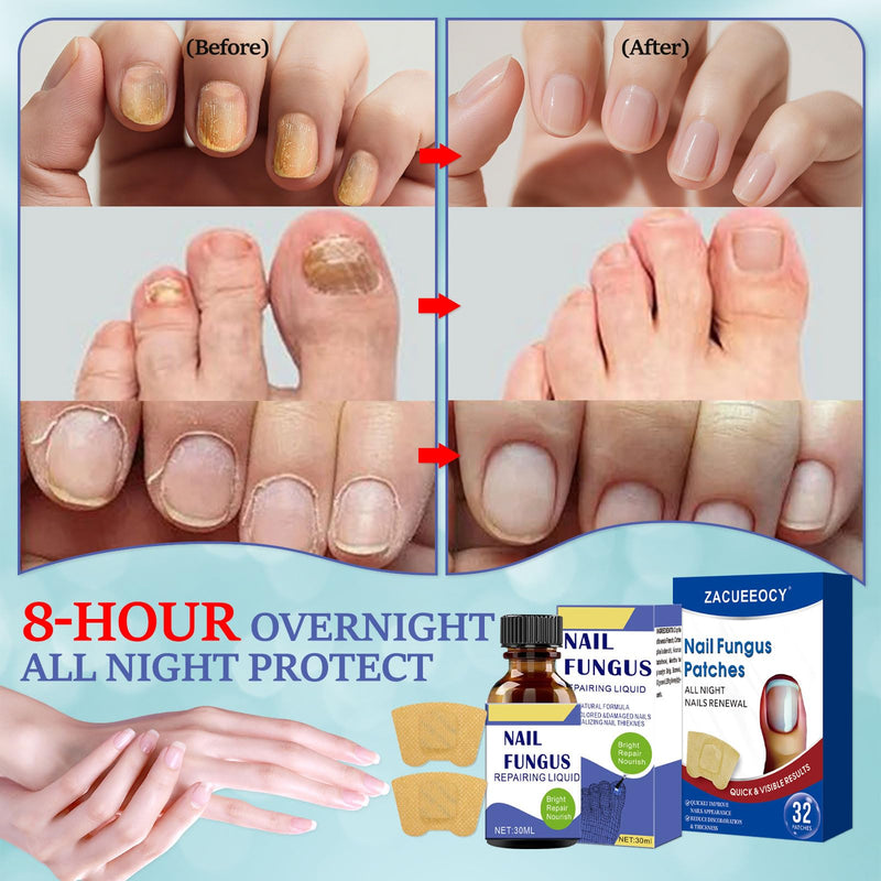 At-Home Intensive Fungal Nail Treatment Kit – 30mL Solution + 32 Renewal Patches, Targets Thickened, Yellowed, Damaged Nails, Precision Applicator for Easy Use on Toenails & Fingernails