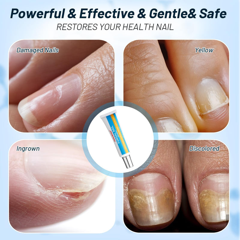 Toenail Fungus Treatment Extra Strength, AntiFungal Ointment for Ingrown, Yellow, Discolored and Damaged Nails, Gentle & Effective.