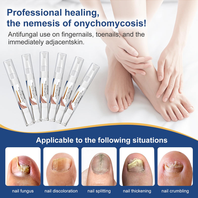 Toenail Fungi Treatment Extra Strength - Fungi Nail Pen, 25% Undecylenic Acid, Ingrown toenail treatment, Fungus nail treatment, yellow toenail, Damaged Nails foot fungus treatment extra strength 0.18 Fl Oz (Pack of 6) 6pcs