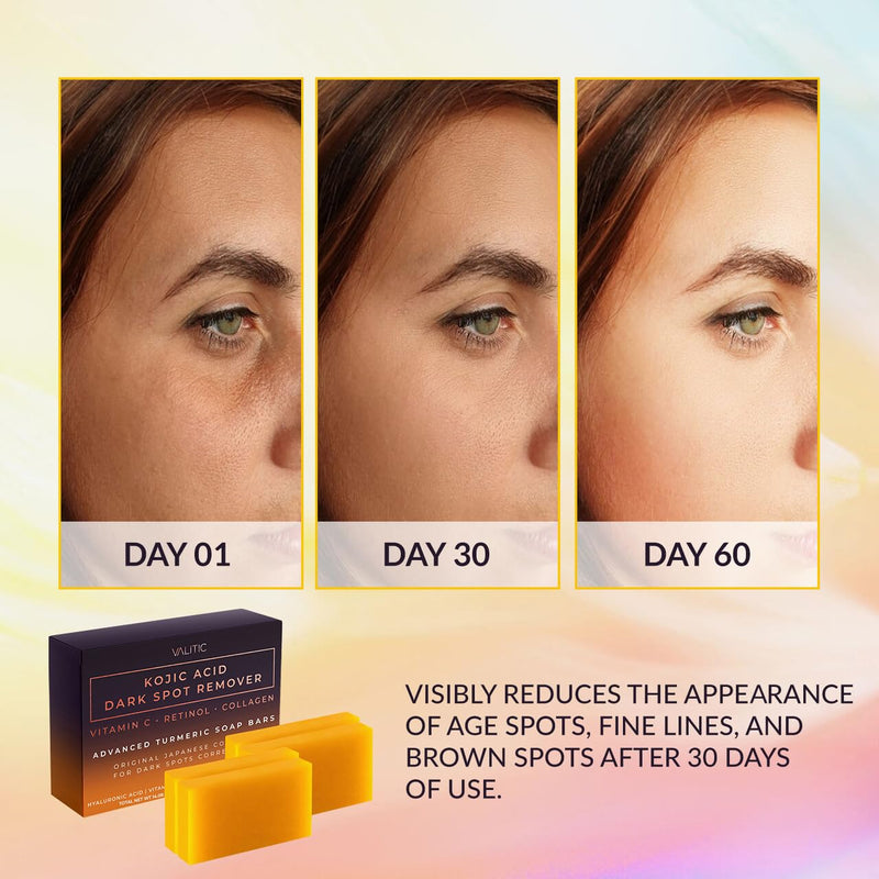 Valitic Kojic Acid Dark Spot Remover Soap Bar with Vitamin C, Retinol, Collagen, Turmeric - Original Japanese Complex - Hyaluronic Acid, Vitamin E, Shea Butter, Castile Oil ( 4 Pack ) With Soap Holder 4 Pack + Holder