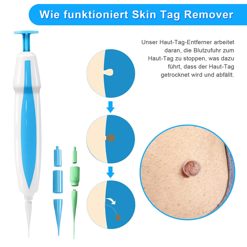[Australia] - Scettar stalked wart remover, wart remover for micro to large (1mm-8mm) with 60 tag bands, safe and painless wart remover stalked warts A 