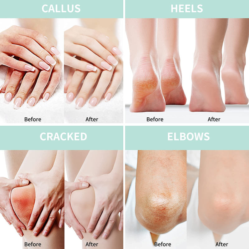 [Australia] - Grocerism 2 Packs Urea Cream 40% Plus 2% Salicylic Acid 5.30 oz || Foot Cream Maximum Strength with Hyaluronic Acid, Tea Tree, and Aloe Vera for Deep Moisturizes, Callus Remover and Soften 10.58 Ounce (Pack of 2) 40% 