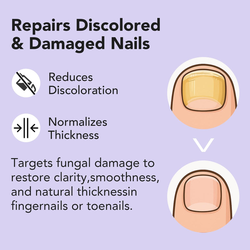 Toenail Fungus Treatment Extra Strength, 30ML Fungal Nail Treatment for Thick, Yellow, Discolored Nails, 4 Weeks Toe Nail Fungus Treatment, Ingrown Toenail, Athletes Foot, Nail Growth & Strengthener
