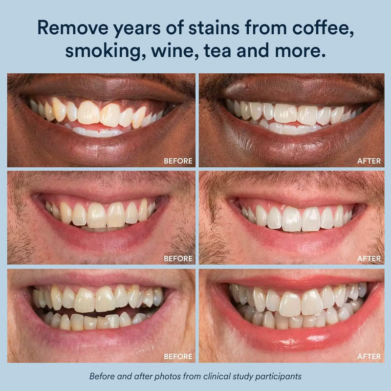 [Australia] - Auraglow Teeth Whitening Pen, Overnight Teeth Whitening Pen, 35% Carbamide Peroxide, 20+ Whitening Treatments, No Sensitivity, 2.8mL 