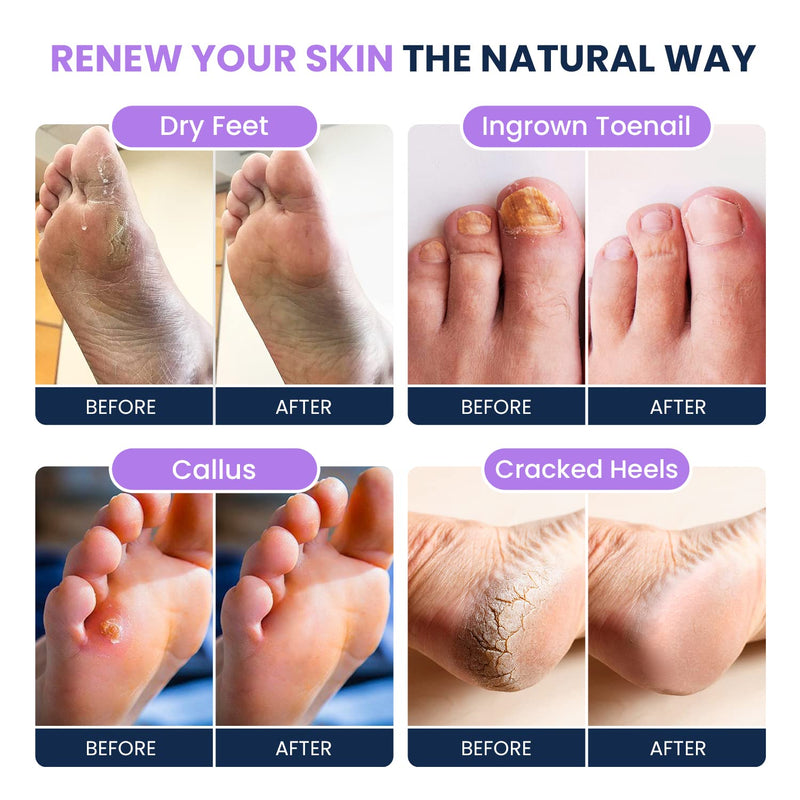 [Australia] - Soothing Lavender Foot Soak with Epsom Salt - Best Toenail Treatment, & Softens Calluses - Soothes Sore & Tired Feet, Moisturizing Athletes Foot Care For Dry Cracked Feet Cream 