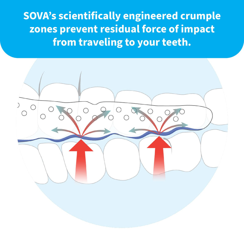 [Australia] - SOVA Aero Night Guard with Case - 1.6mm Thin - Custom-Molded Fit - Protects Against Nighttime Teeth Grinding & Clenching - FSA/HSA Eligible - Odor & Taste Free - Remoldable Up to 20 Times - Non Toxic 