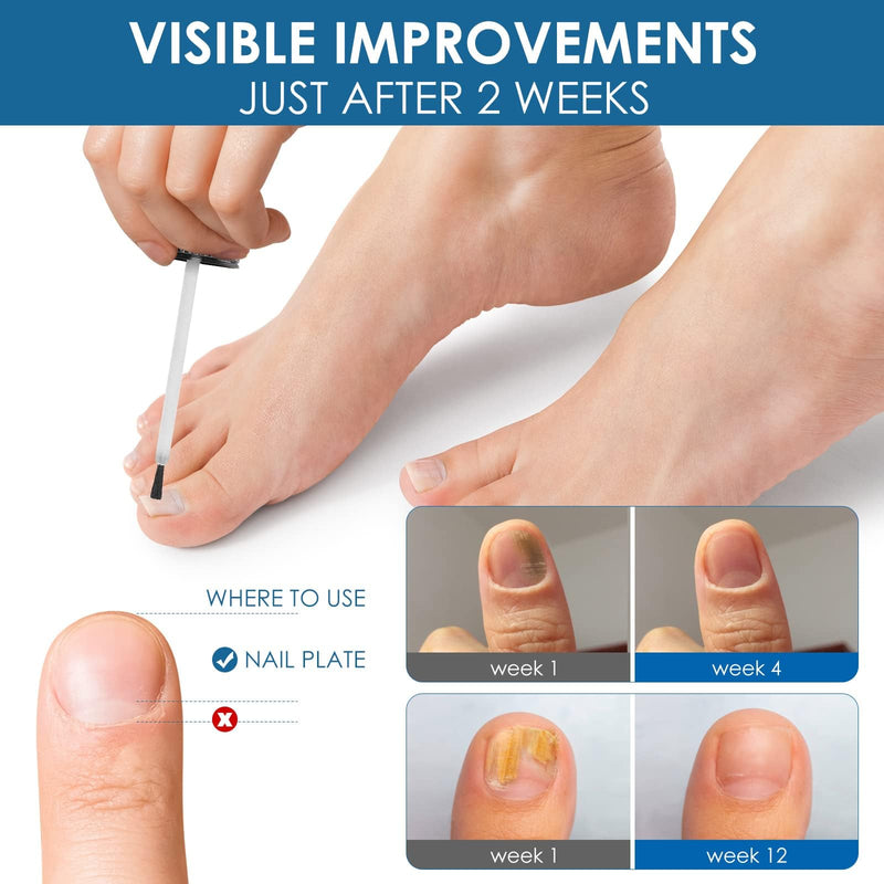 [Australia] - Toenail Fungus Treatment Extra Strength, Toe Fungus Treatment for Toenail, Toe Nail fungus Treatment Extra Strength, Nail Treatment, Safely and Gently 1 Fl Oz (Pack of 1) 1 Fl Oz (Pack of 1) 