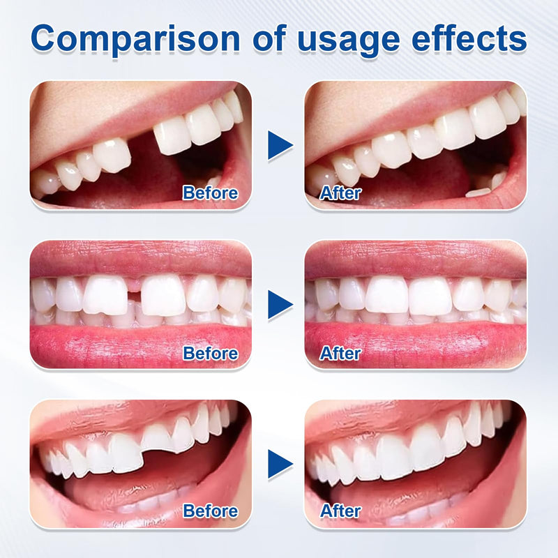 [Australia] - Tooth Repair Set Tooth Repair Set Tooth Repair Set Permanent Make Your Own Tooth Filling Make Your Own Temporary Dentures for Repairing Gaps in Broken Teeth with 4 Tools, 30g+5g 