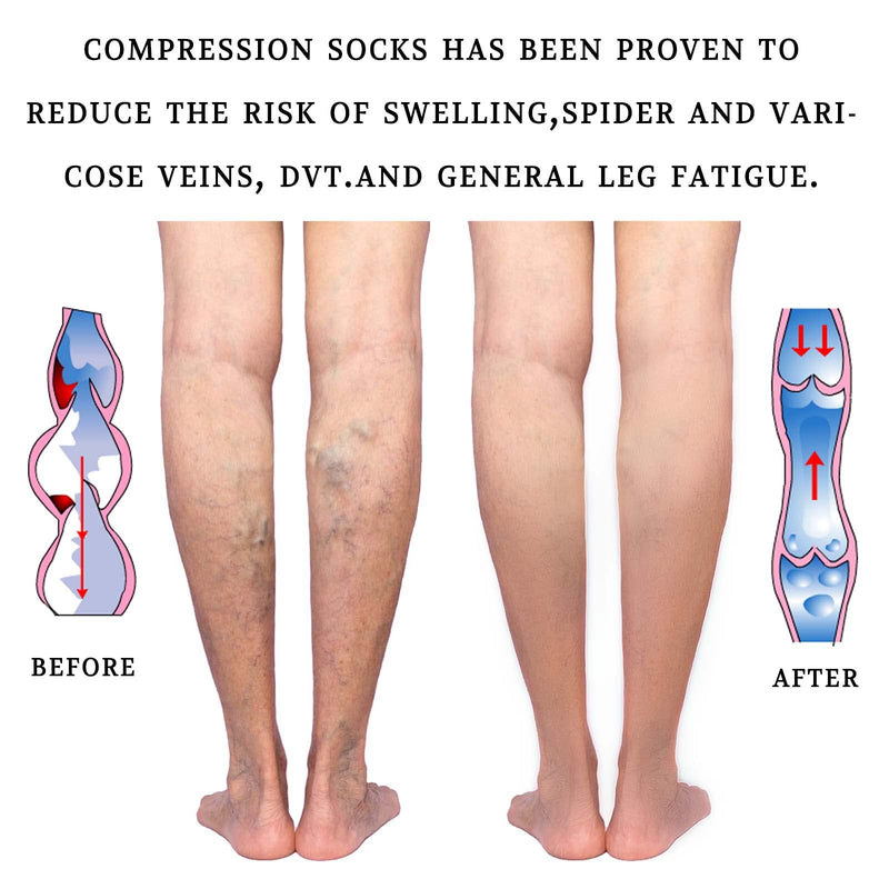 [Australia] - Lin Performance 15-20 mmHg Medical Compression Stockings for Women and Men Thigh High Dot-Top Open Toe Socks for Varicose Vein Swollen legs Travel Flight Pregnant(Beige,M) Beige Medium 