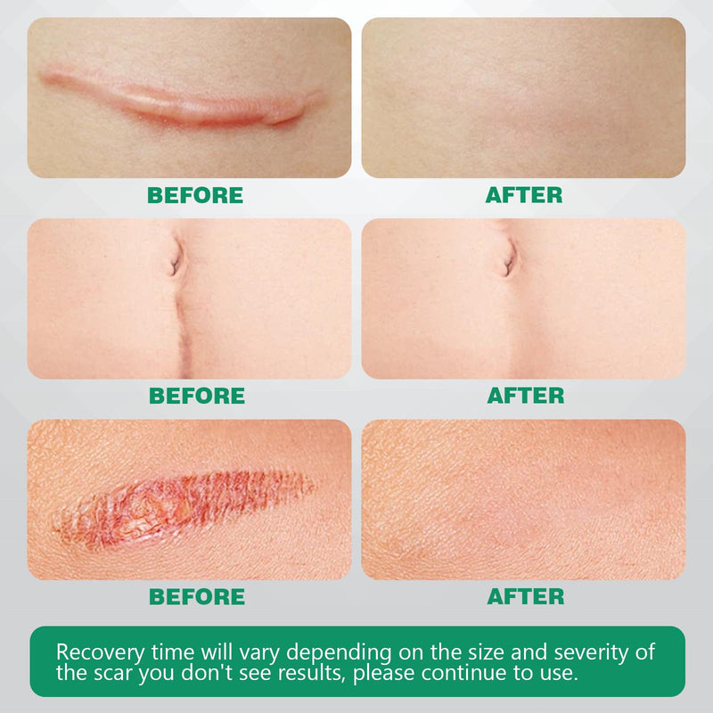 [Australia] - Silicone Plaster for Scars Scar Plaster Silicone Scar Tape Silicone Plaster for Scars Scar Tape Ultra Thin Soft and Breathable Suitable for Burns and Cesarean Section Scars (4 * 150 cm) 