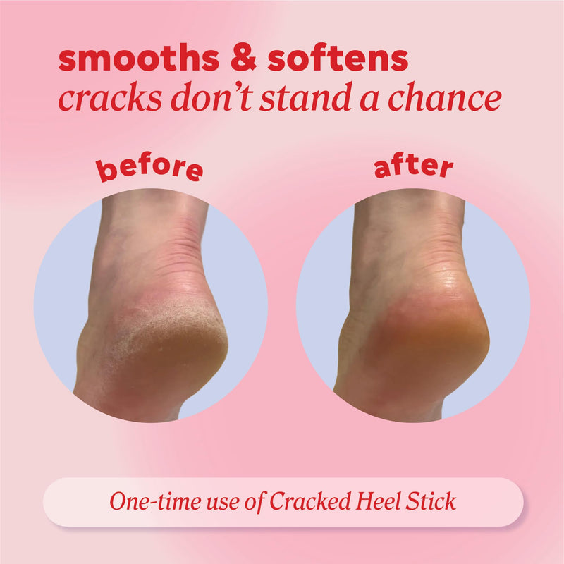 Onyx Professional Cracked Heel Repair Balm Stick for Dry Cracked Feet Treatment, Citrus Scent, 2 pack - Moisturizing Foot Balm, Rolls On, No Mess Like Foot Cream or Foot Lotion, Heel Treatment 2.46 Ounce (Pack of 2)